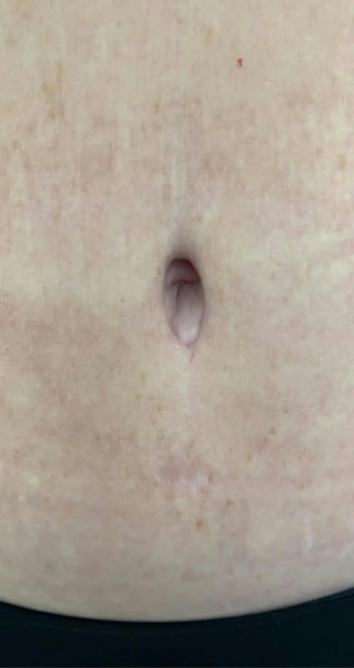 Belly Button Before & After Gallery - Patient 103529 - Image 2