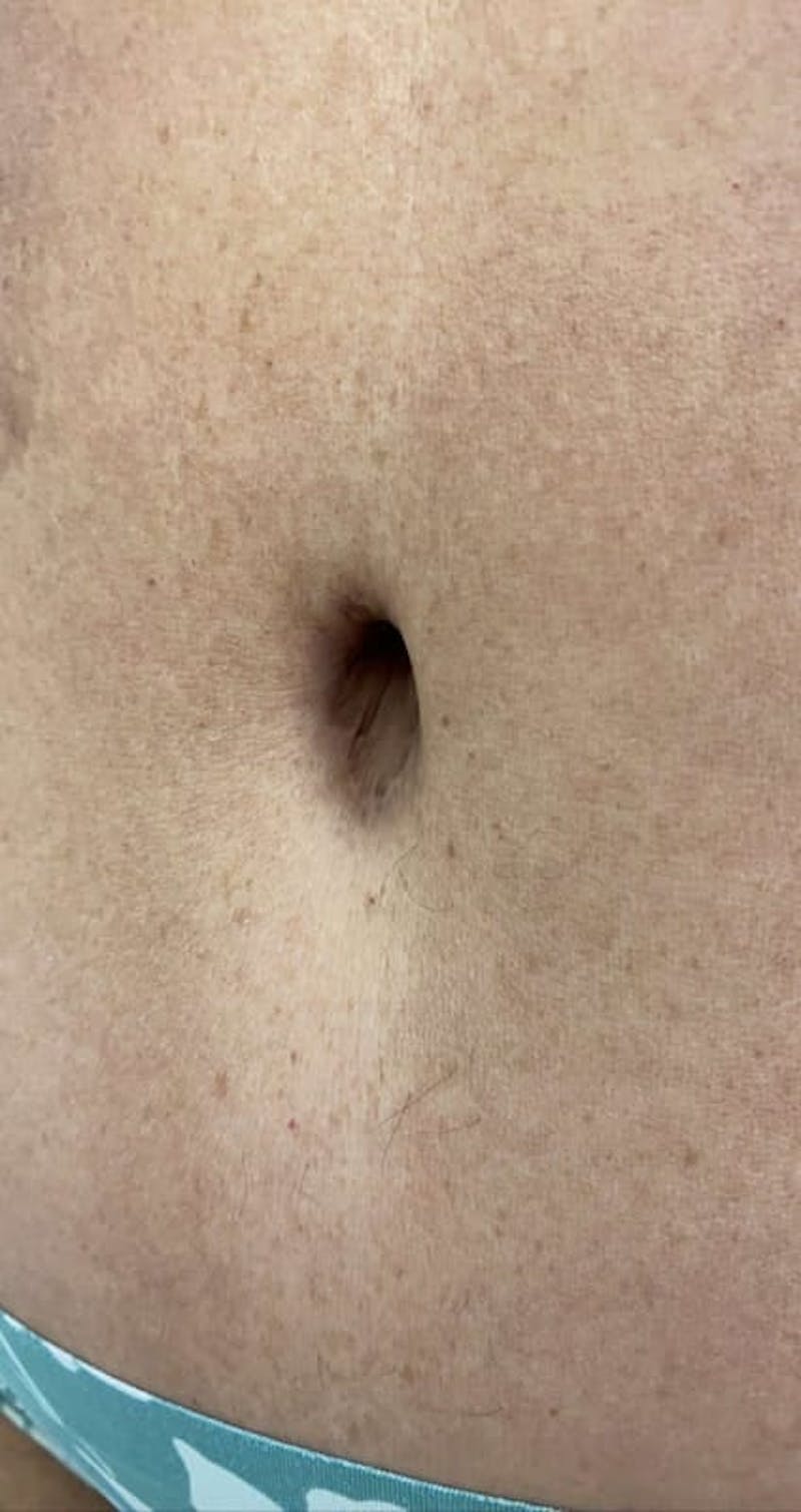Belly Button Before & After Gallery - Patient 422925 - Image 1