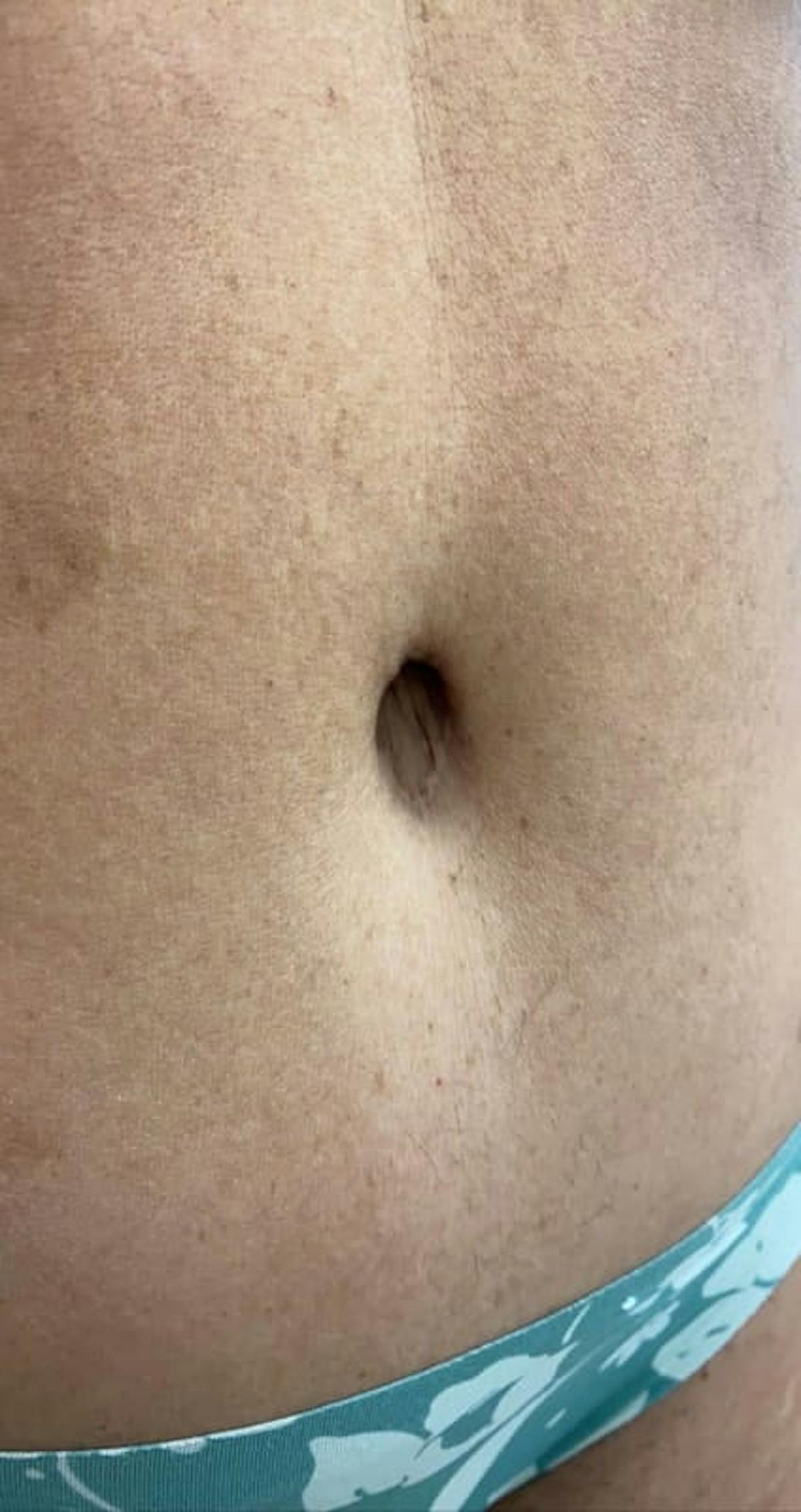 Belly Button Before & After Gallery - Patient 422925 - Image 2