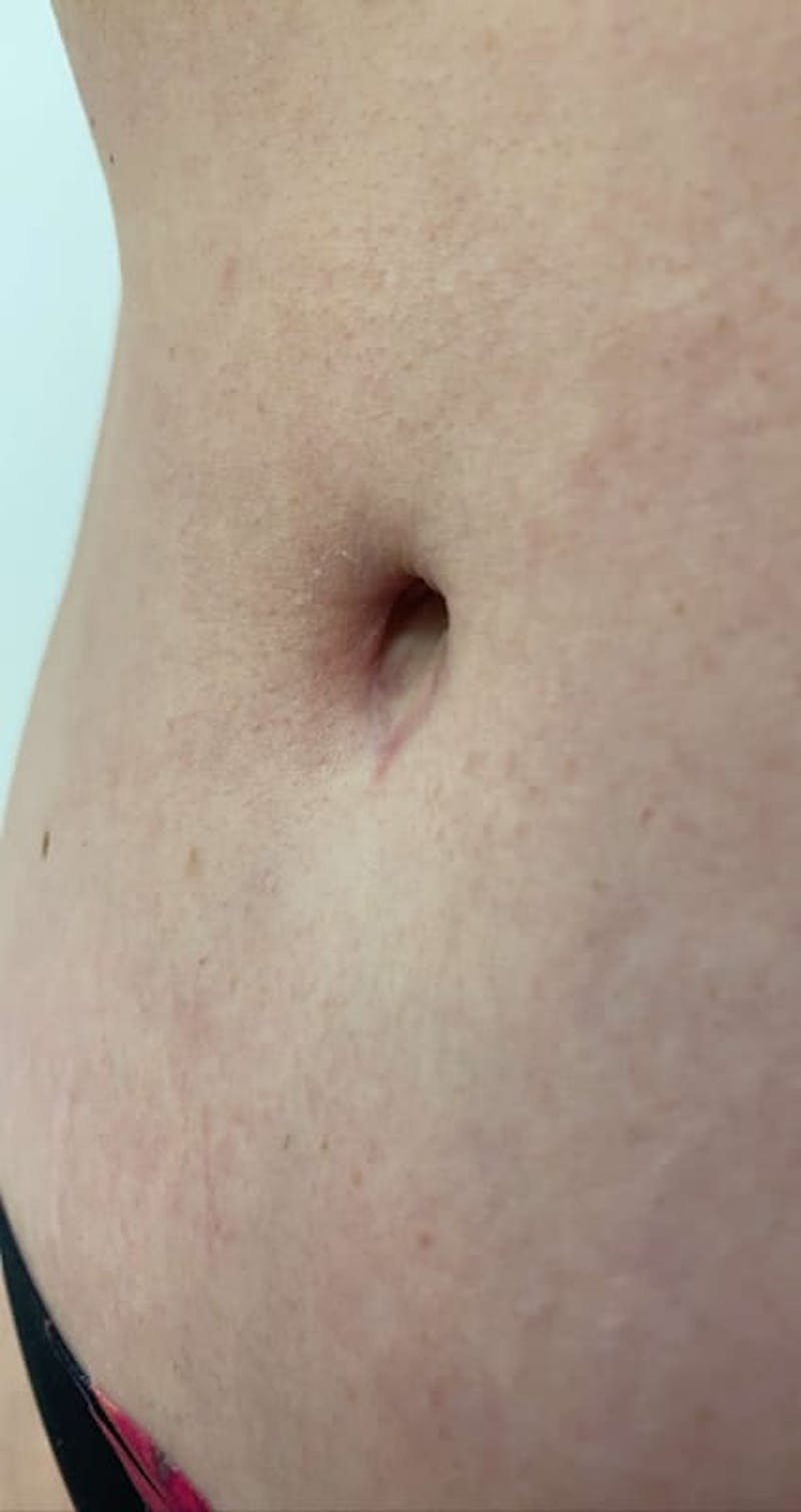 Belly Button Before & After Gallery - Patient 767777 - Image 1