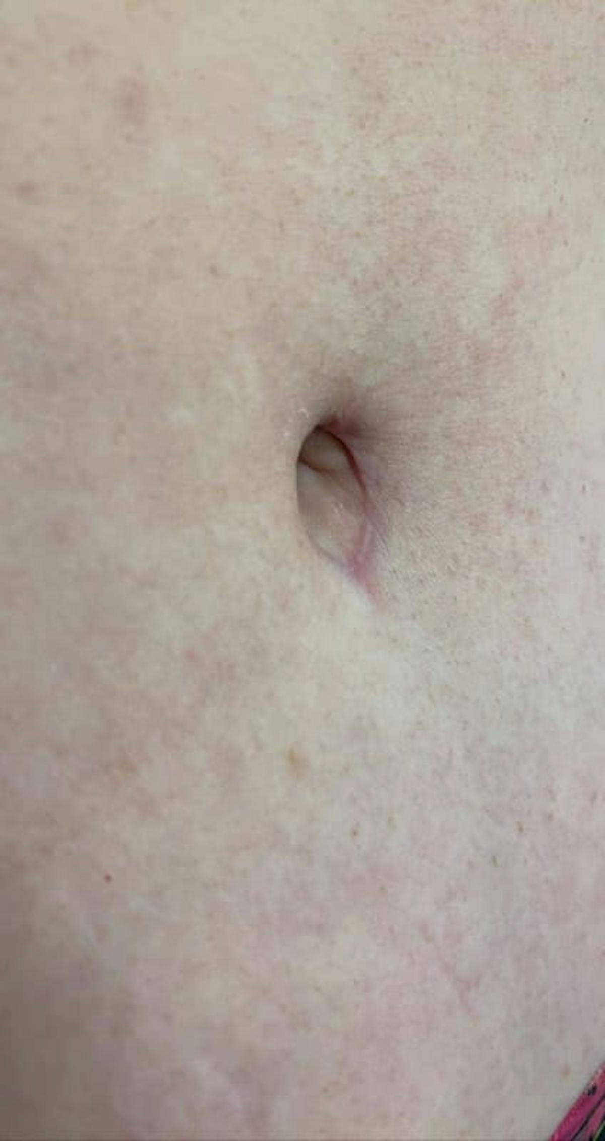 Belly Button Before & After Gallery - Patient 767777 - Image 2