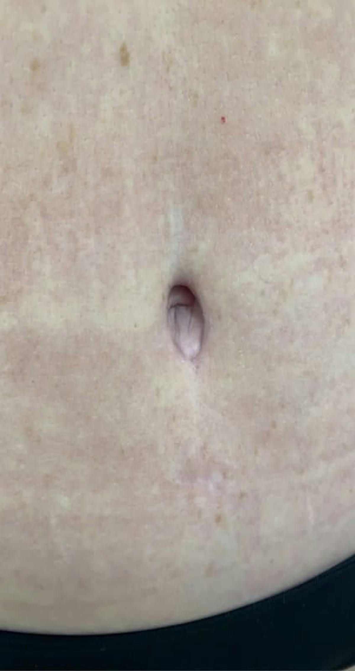 Belly Button Before & After Gallery - Patient 767777 - Image 3