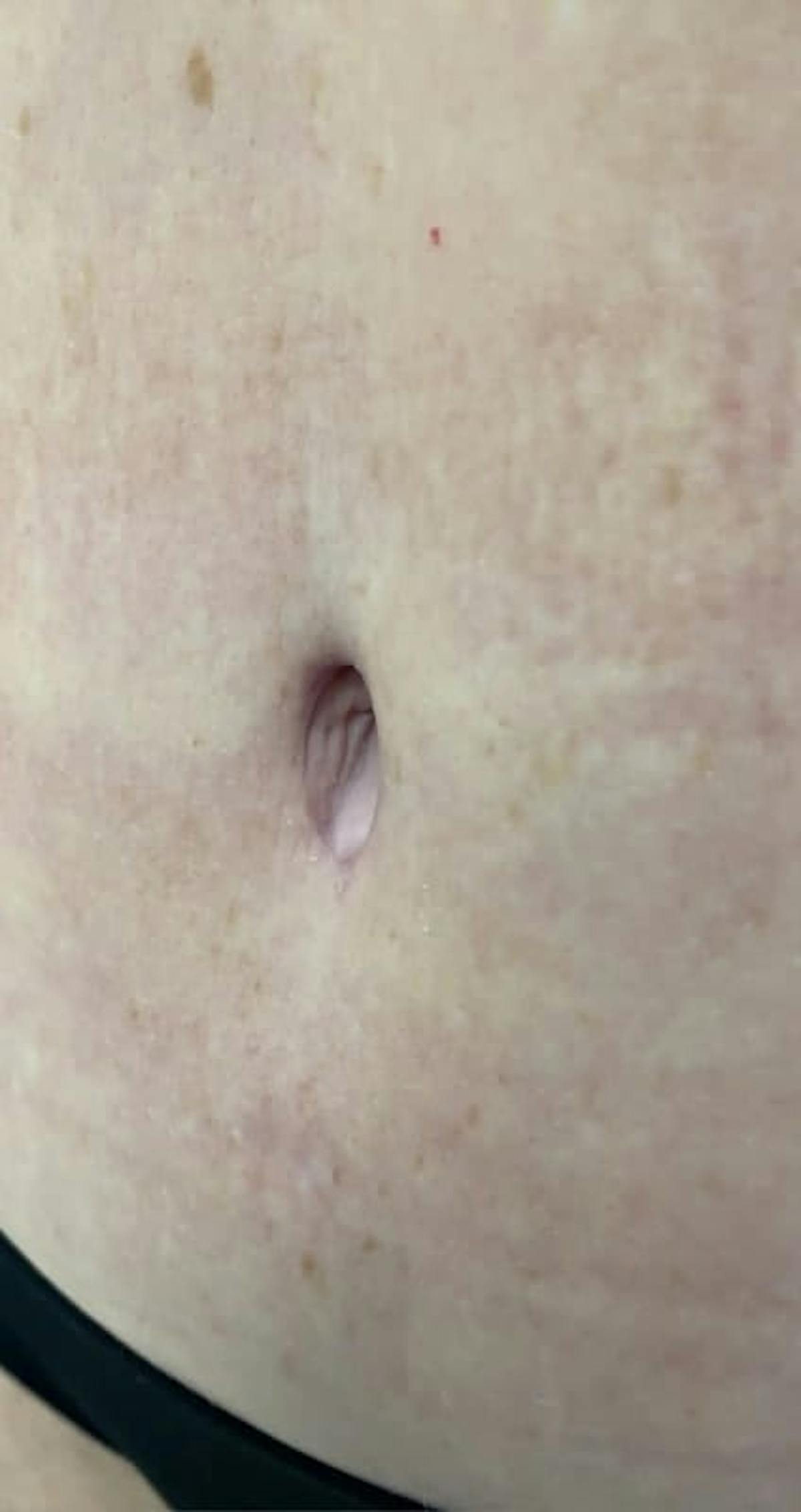Belly Button Before & After Gallery - Patient 767777 - Image 4