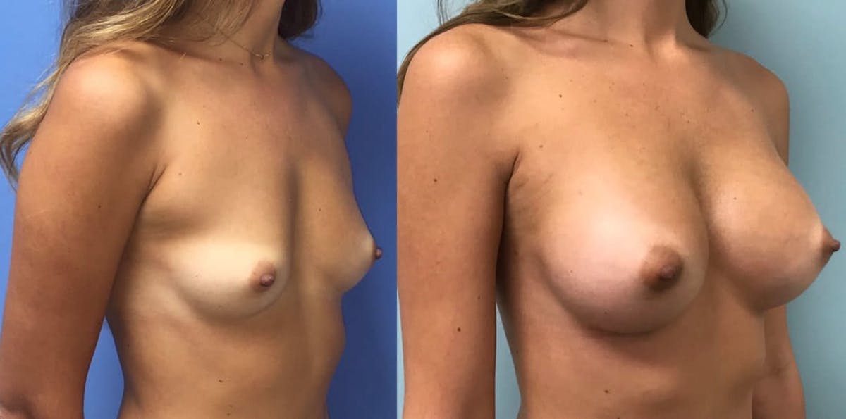 Breast Augmentation Before & After Gallery - Patient 197843 - Image 2
