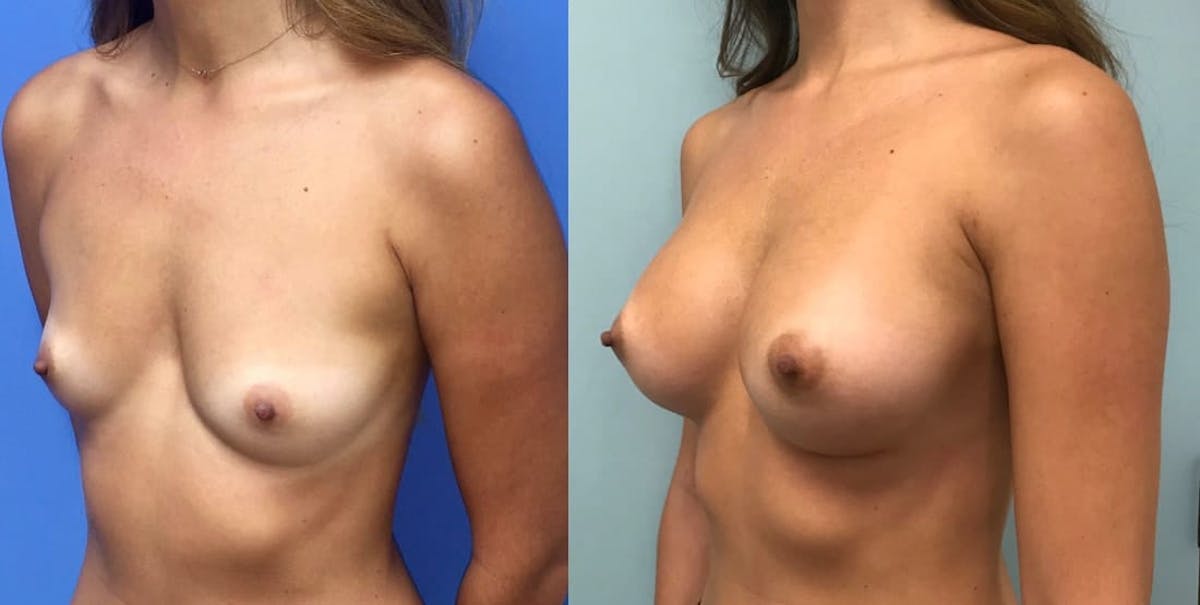 Breast Augmentation Before & After Gallery - Patient 197843 - Image 3