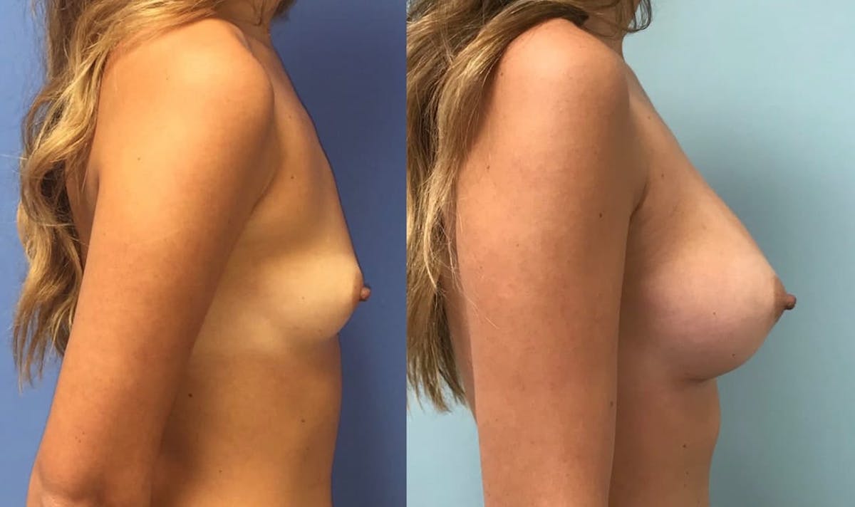 Breast Augmentation Before & After Gallery - Patient 197843 - Image 5