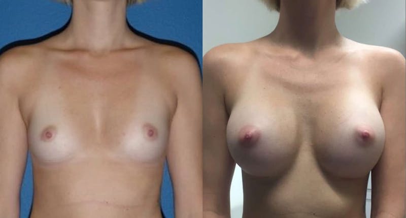 Breast Augmentation Before & After Gallery - Patient 108390 - Image 1