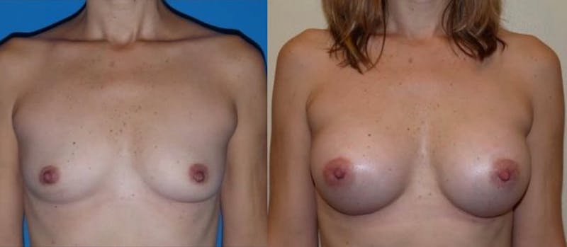 Breast Augmentation Before & After Gallery - Patient 250401 - Image 1