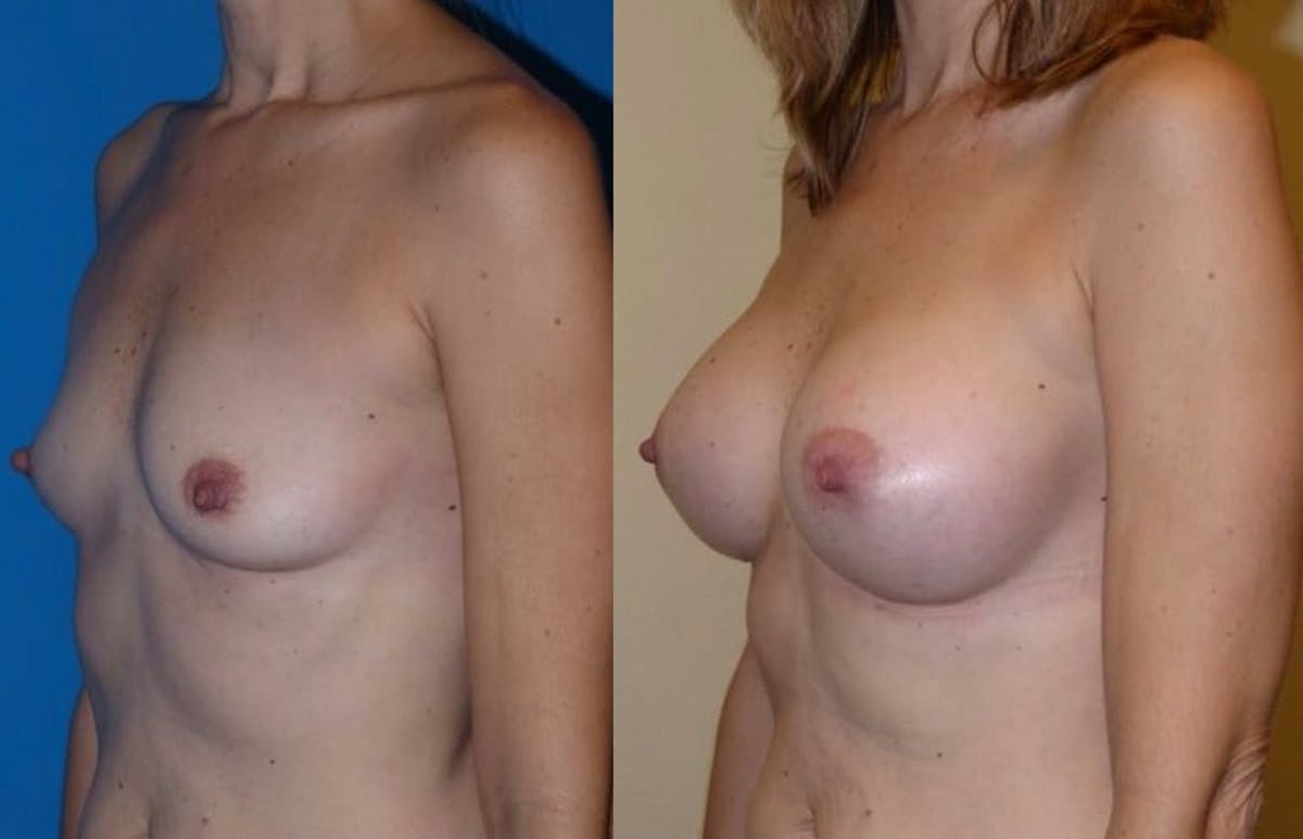 Breast Augmentation Before & After Gallery - Patient 250401 - Image 2