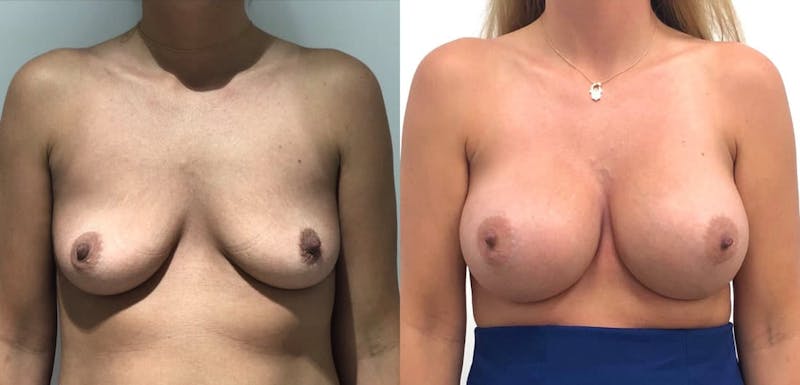 Breast Augmentation Before & After Gallery - Patient 579091 - Image 1