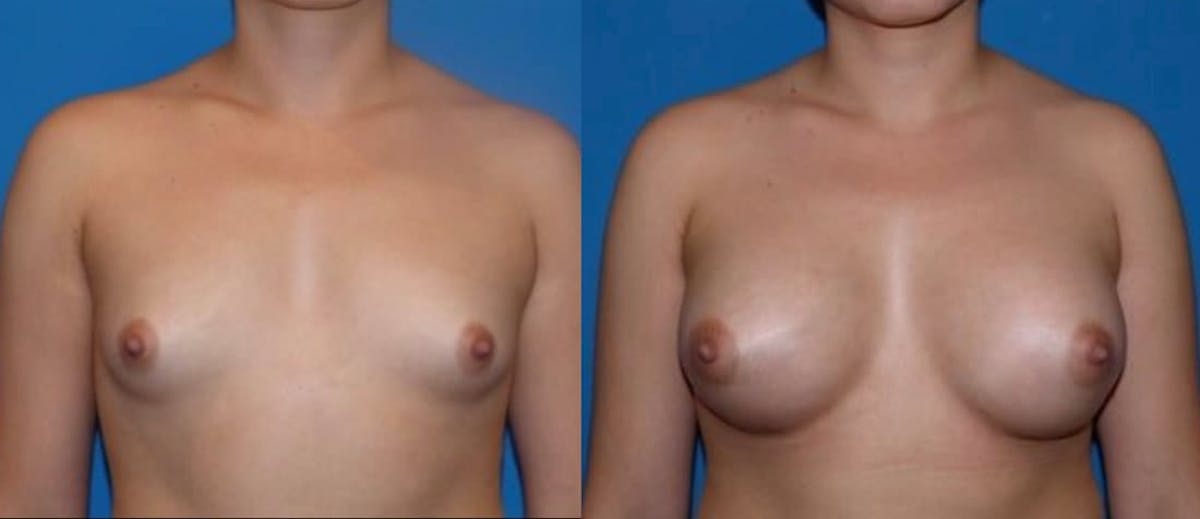 Breast Augmentation Before & After Gallery - Patient 247556 - Image 1