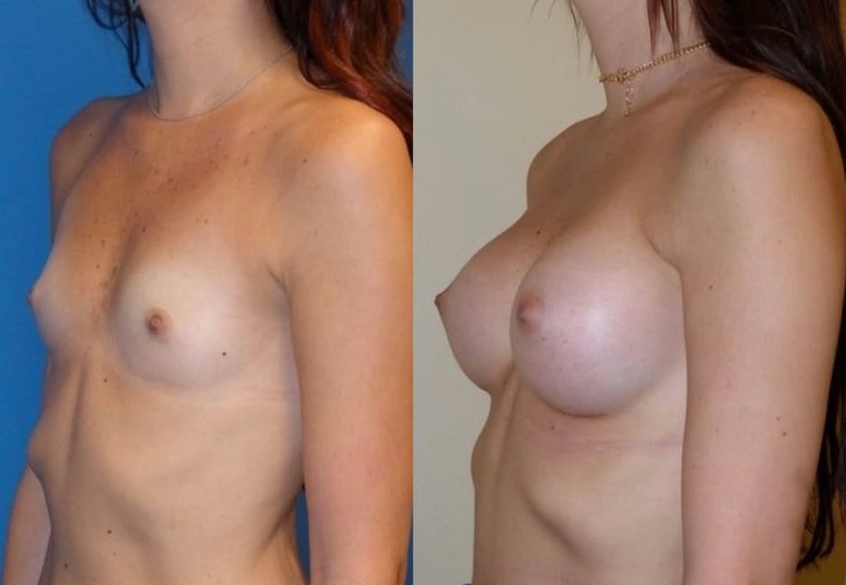 Breast Augmentation Before & After Gallery - Patient 293348 - Image 1