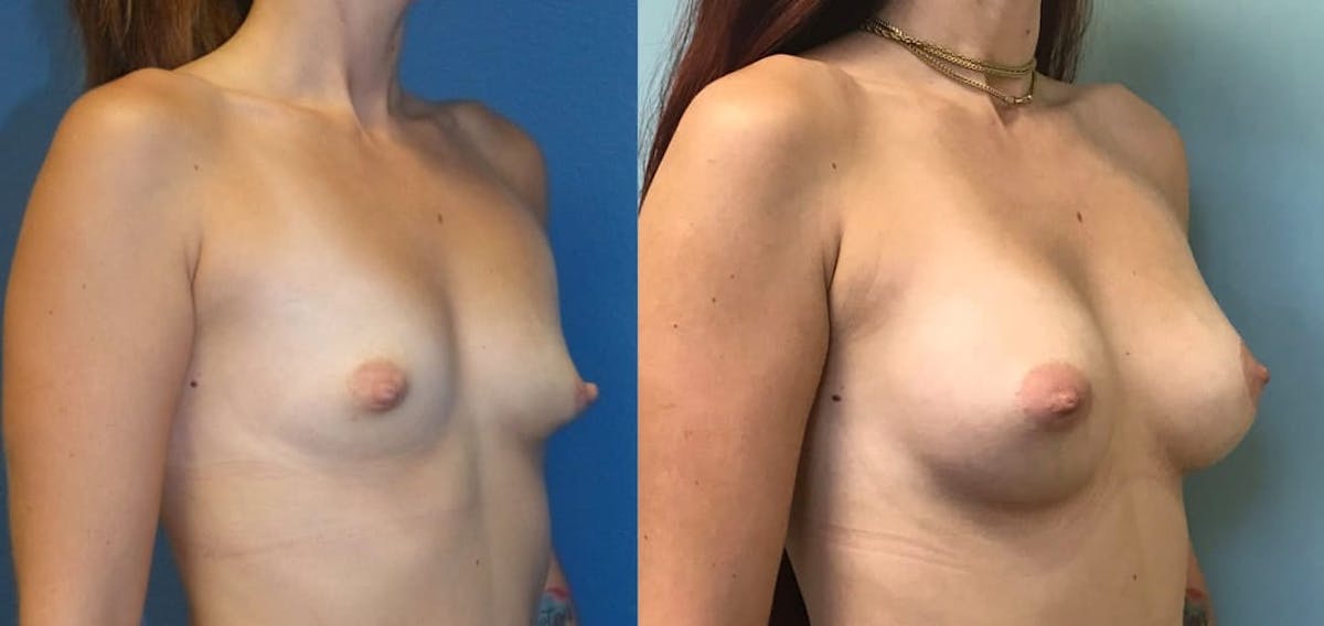 Breast Augmentation Before & After Gallery - Patient 265824 - Image 1