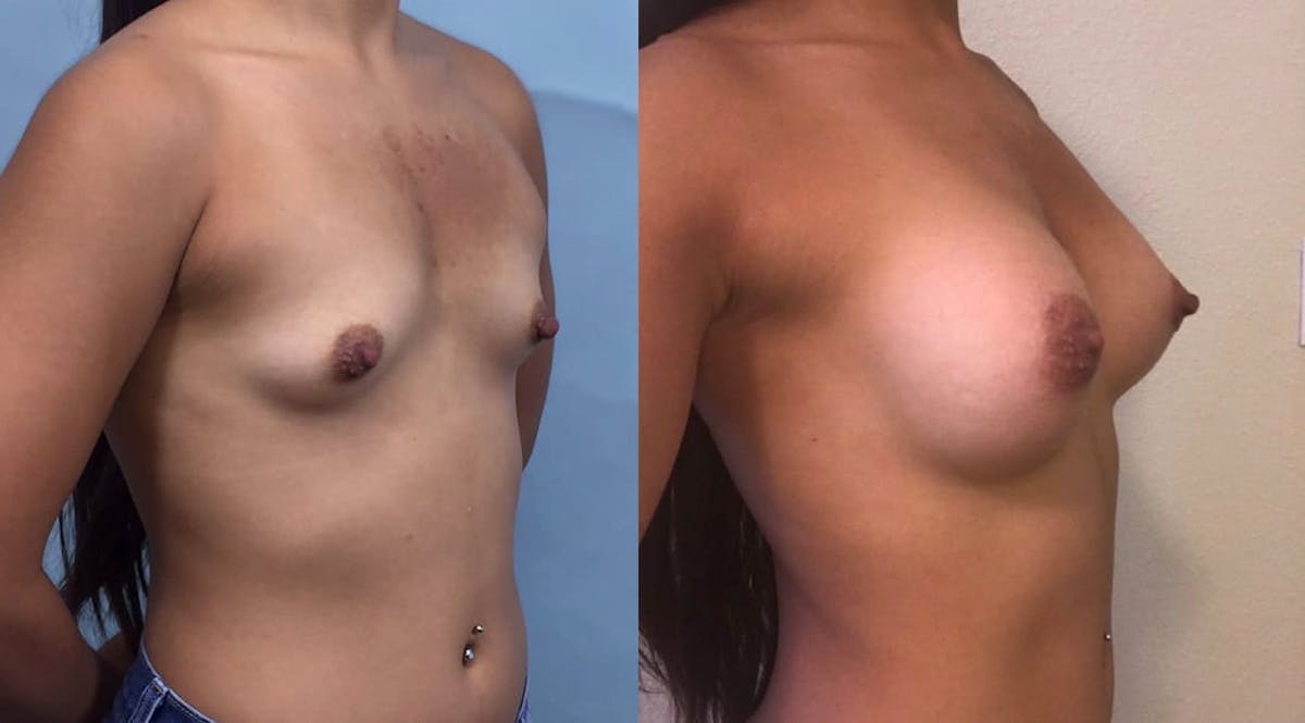 Breast Augmentation Before & After Gallery - Patient 718353 - Image 1