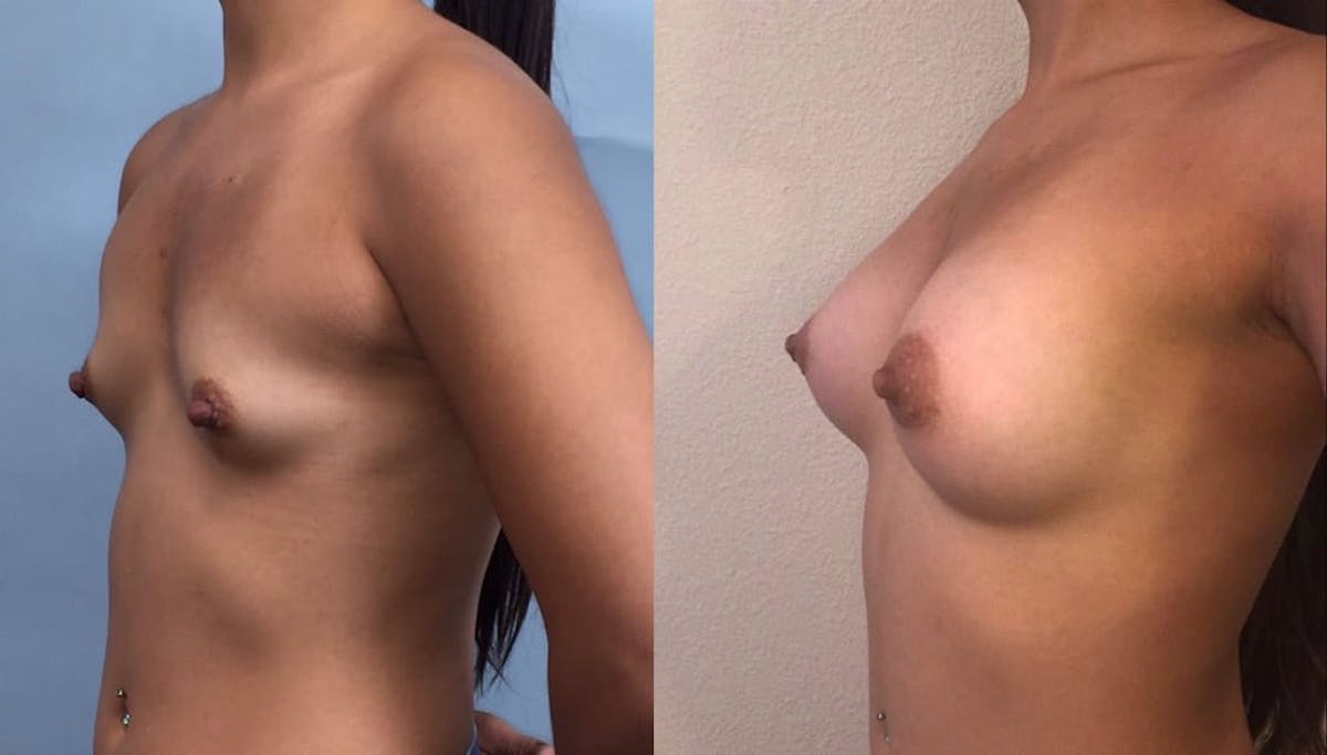 Breast Augmentation Before & After Gallery - Patient 718353 - Image 2