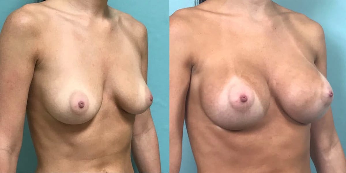 Breast Augmentation Before & After Gallery - Patient 159707 - Image 1