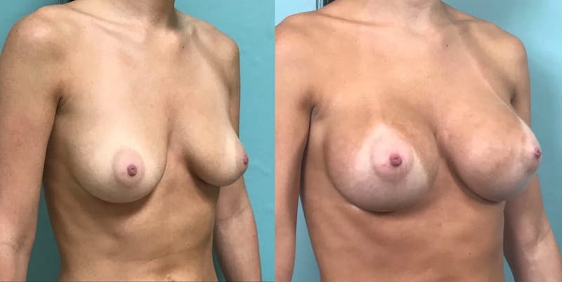 Breast Augmentation Before & After Gallery - Patient 159707 - Image 1