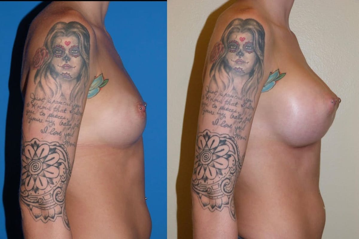 Breast Augmentation Before & After Gallery - Patient 324827 - Image 2