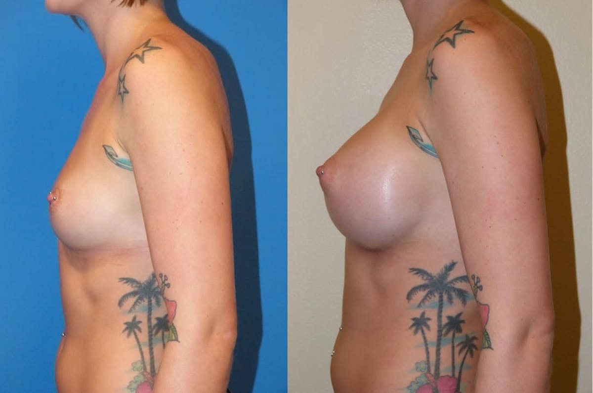 Breast Augmentation Before & After Gallery - Patient 324827 - Image 3