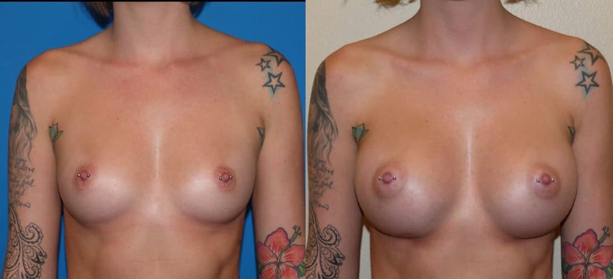 Breast Augmentation Before & After Gallery - Patient 324827 - Image 1