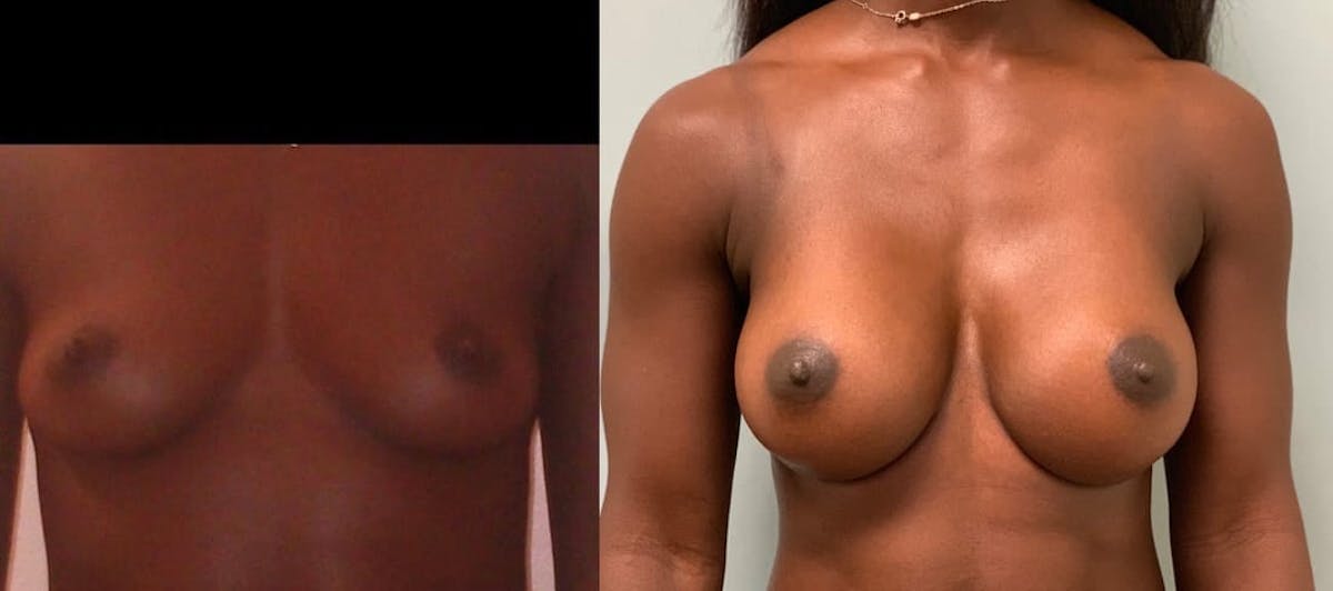 Breast Augmentation Before & After Gallery - Patient 293797 - Image 1