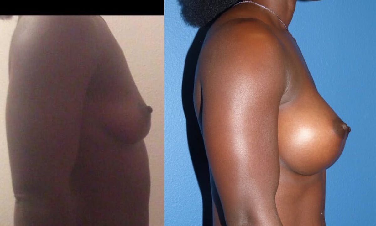 Breast Augmentation Before & After Gallery - Patient 293797 - Image 2