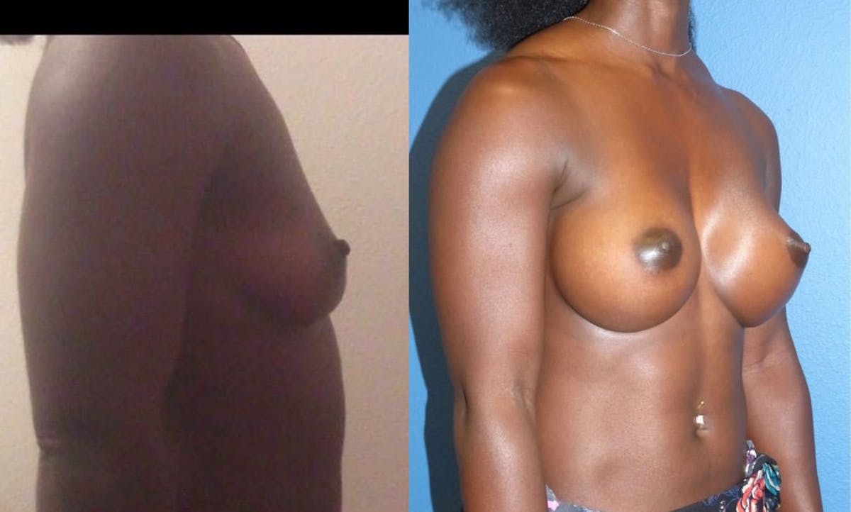Breast Augmentation Before & After Gallery - Patient 293797 - Image 3
