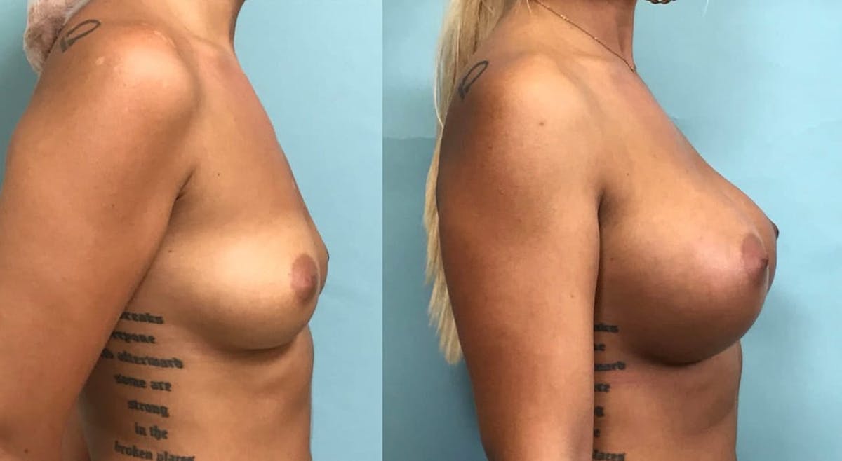 Breast Augmentation Before & After Gallery - Patient 191184 - Image 1