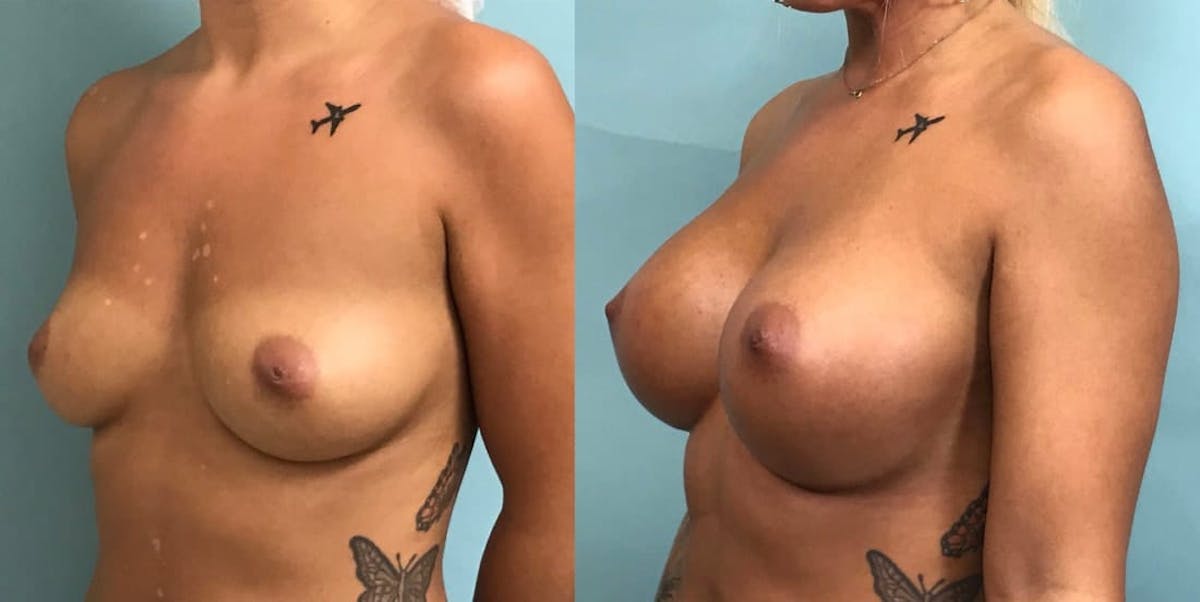 Breast Augmentation Before & After Gallery - Patient 191184 - Image 2
