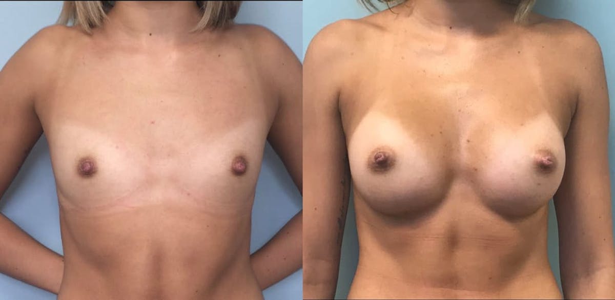 Breast Augmentation Before & After Gallery - Patient 246231 - Image 1