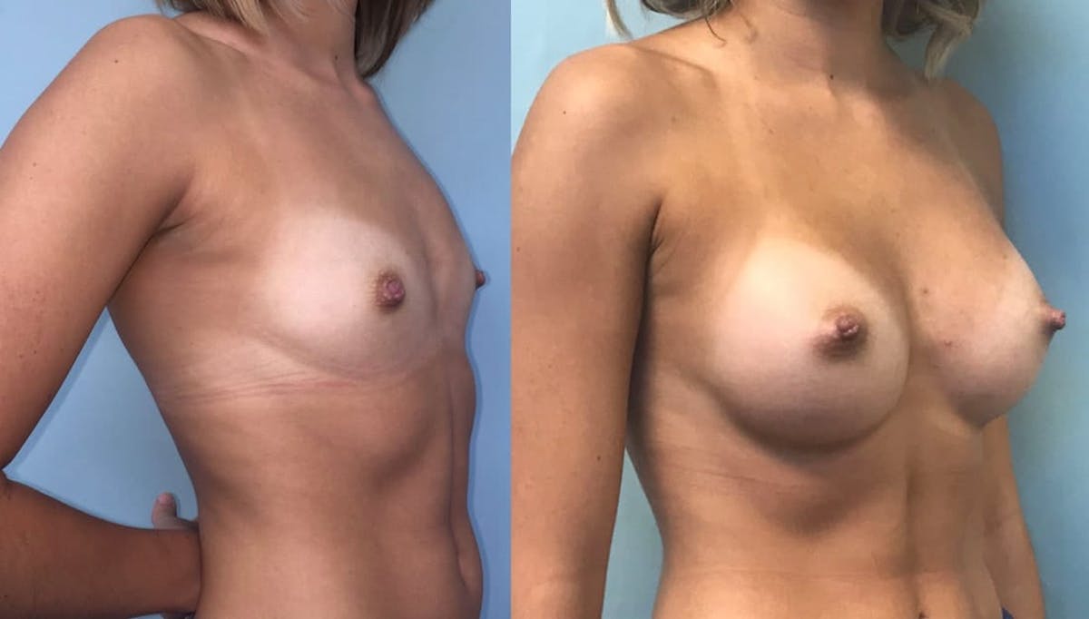 Breast Augmentation Before & After Gallery - Patient 246231 - Image 2