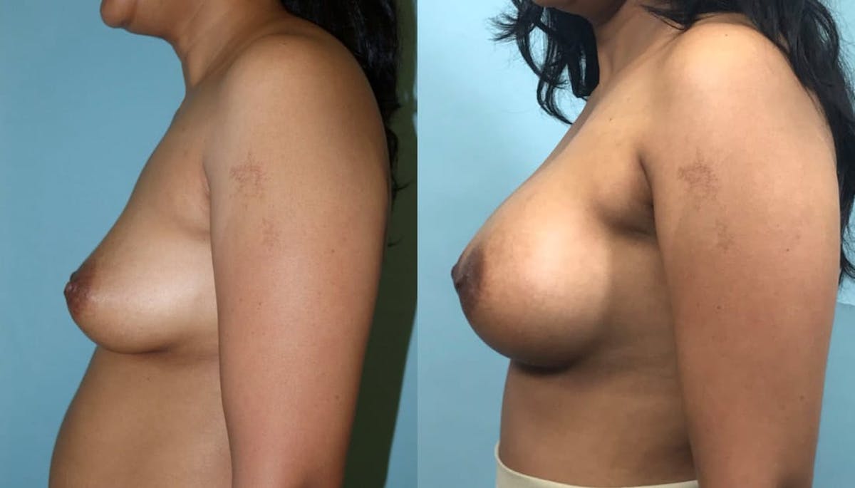 Breast Augmentation Before & After Gallery - Patient 112346 - Image 2