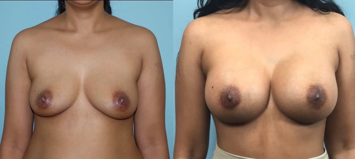 Breast Augmentation Before & After Gallery - Patient 112346 - Image 1
