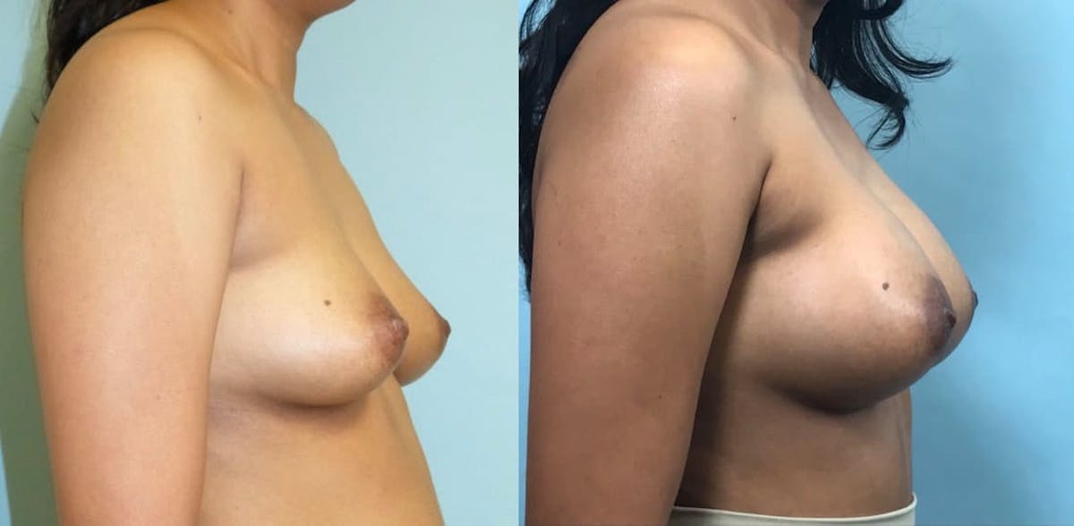 Breast Augmentation Before & After Gallery - Patient 112346 - Image 3