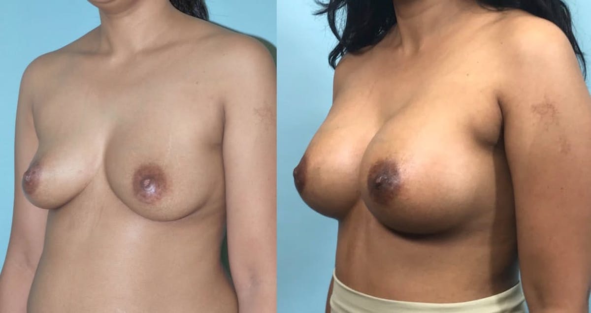 Breast Augmentation Before & After Gallery - Patient 112346 - Image 4