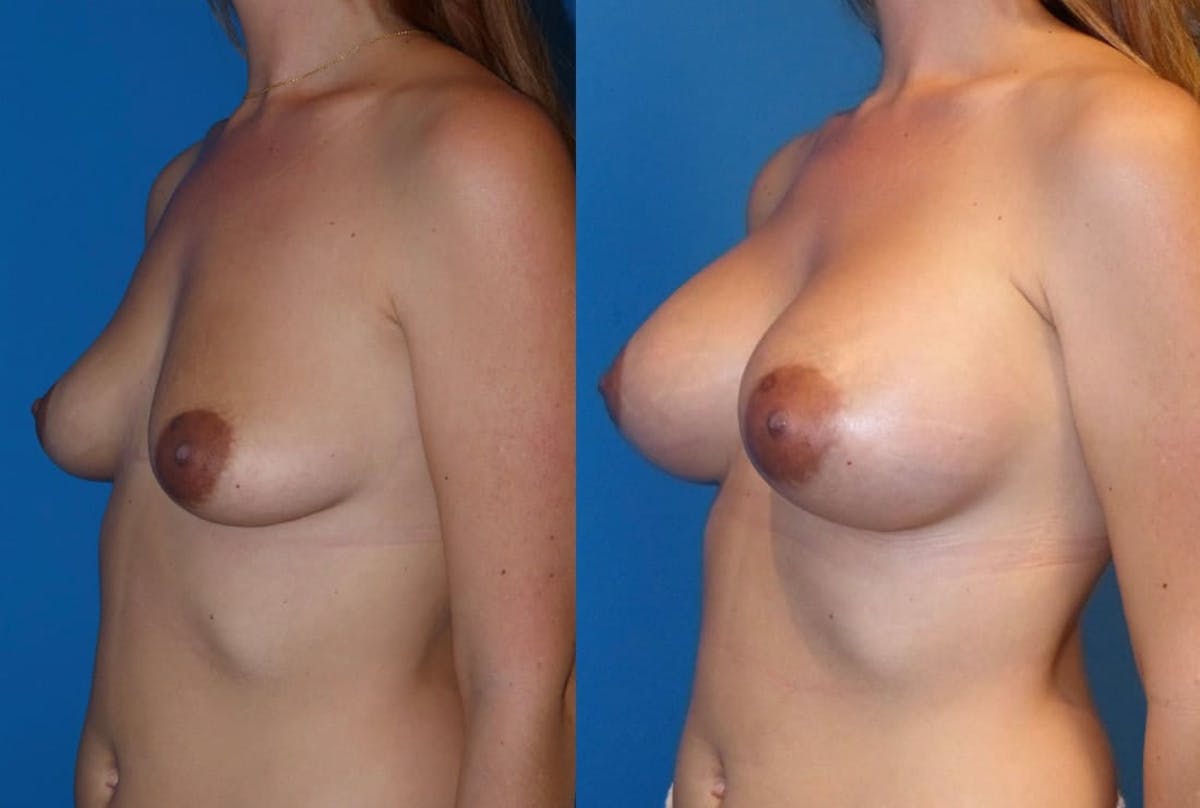 Breast Augmentation Before & After Gallery - Patient 230736 - Image 2