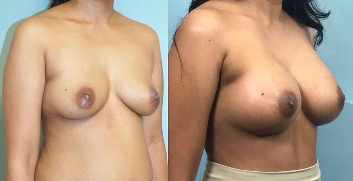 Breast Augmentation Before & After Gallery - Patient 112346 - Image 5