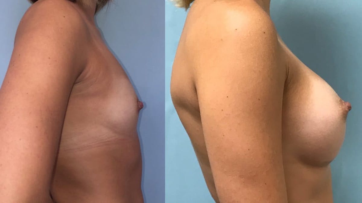 Breast Augmentation Before & After Gallery - Patient 486820 - Image 1