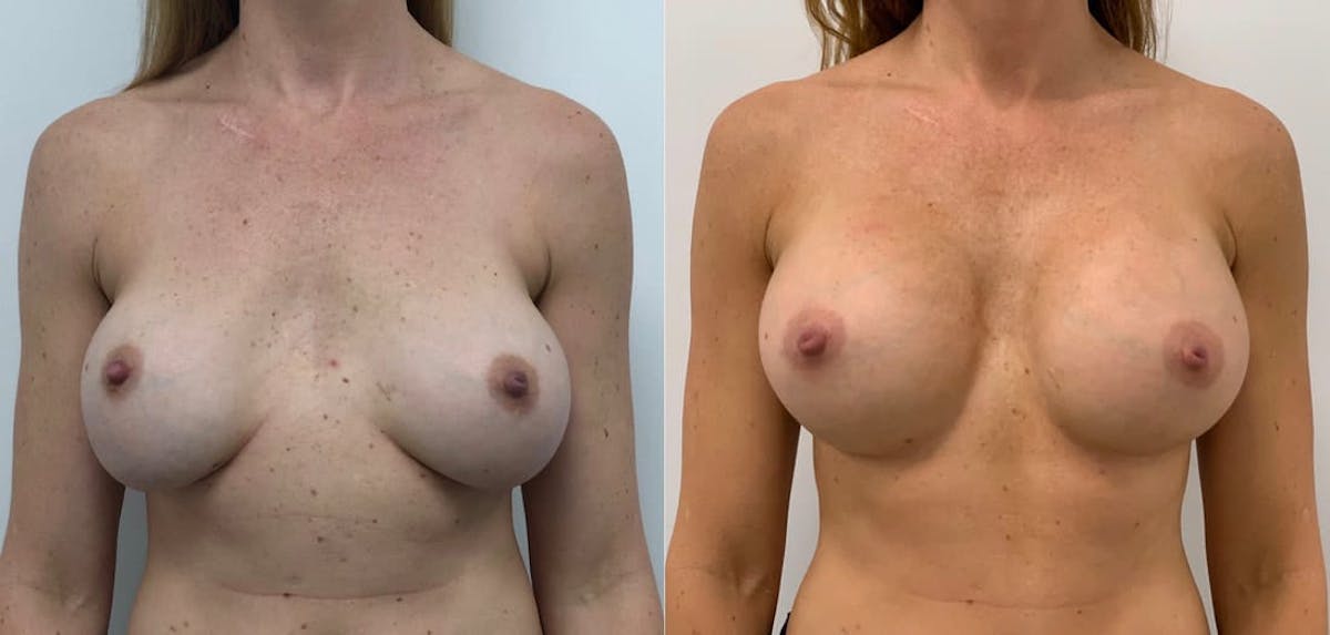 Breast Augmentation Before & After Gallery - Patient 397101 - Image 1