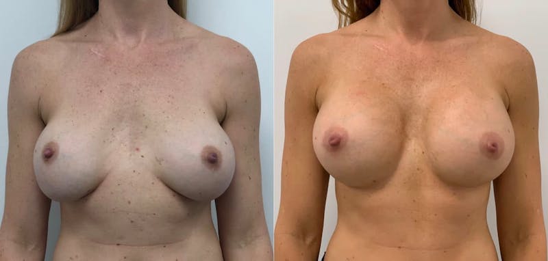 Breast Augmentation Before & After Gallery - Patient 397101 - Image 1