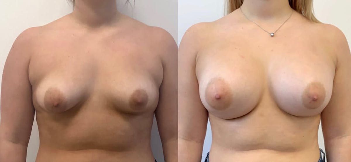 Breast Augmentation Before & After Gallery - Patient 262414 - Image 1