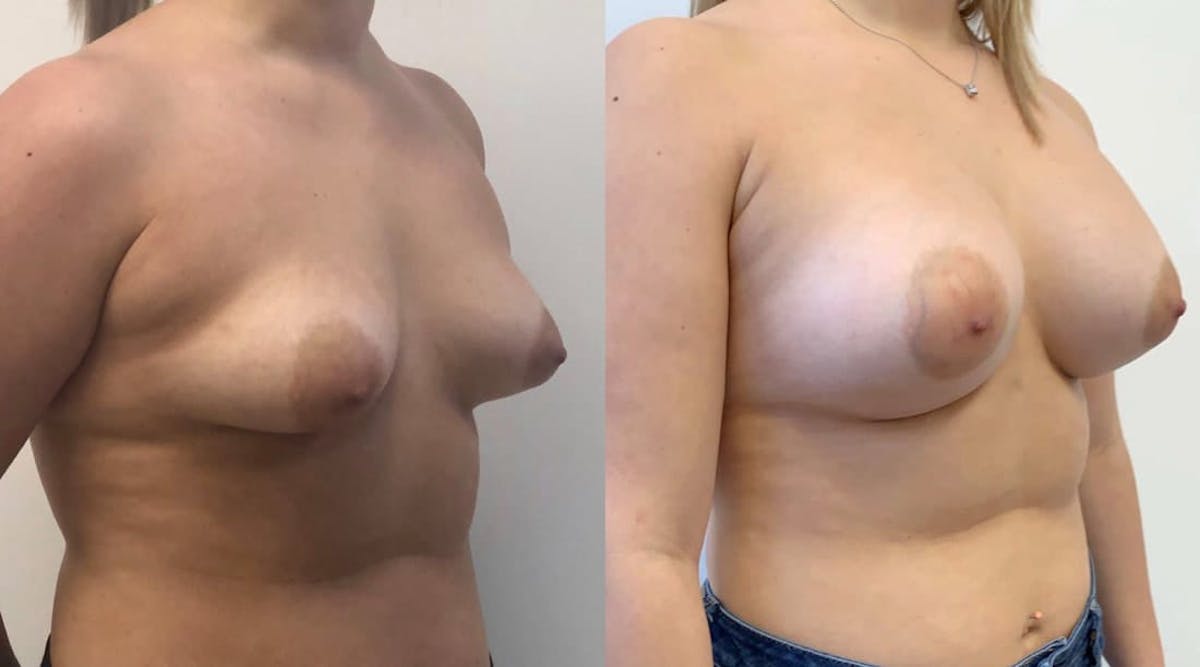 Breast Augmentation Before & After Gallery - Patient 262414 - Image 2