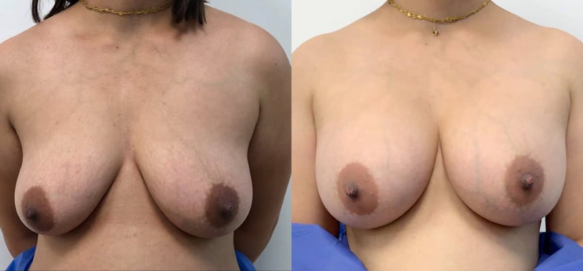 Breast Augmentation Before & After Gallery - Patient 205711 - Image 1