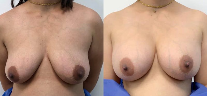 Breast Augmentation Before & After Gallery - Patient 205711 - Image 1