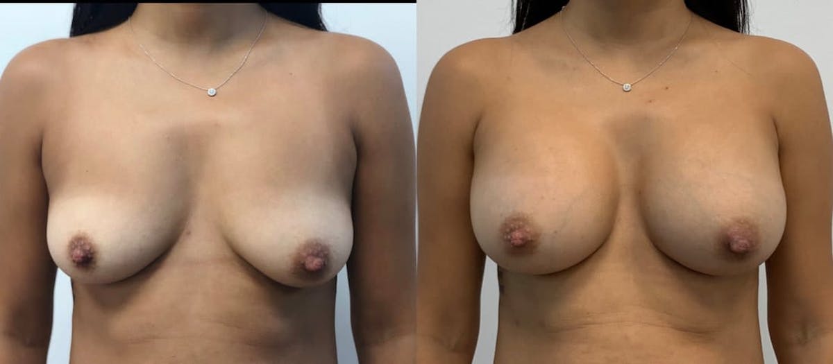 Breast Augmentation Before & After Gallery - Patient 152048 - Image 1