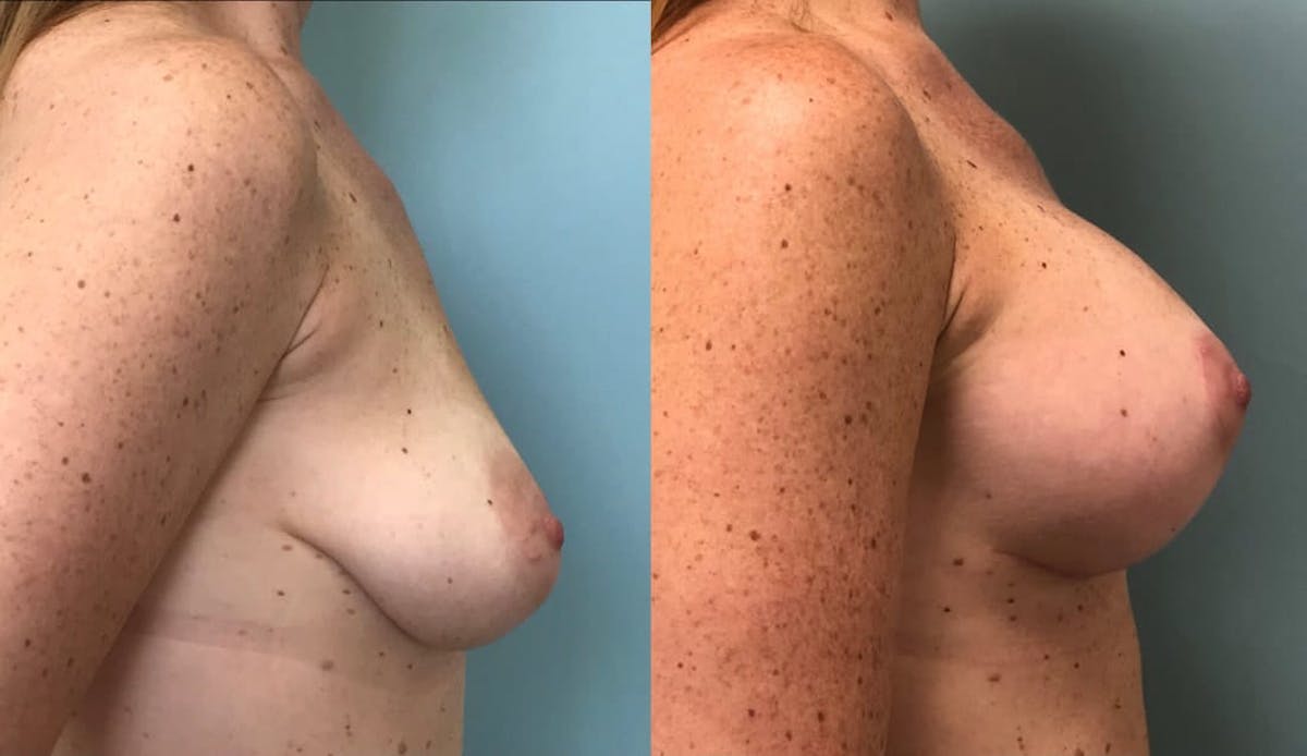 Breast Augmentation Before & After Gallery - Patient 124727 - Image 2
