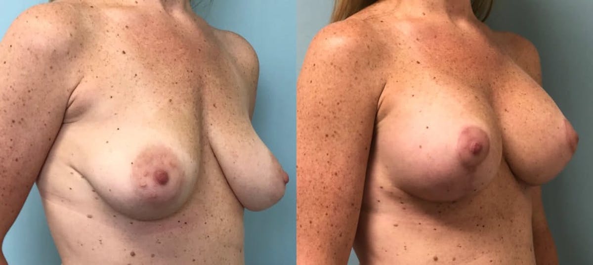 Breast Augmentation Before & After Gallery - Patient 124727 - Image 3