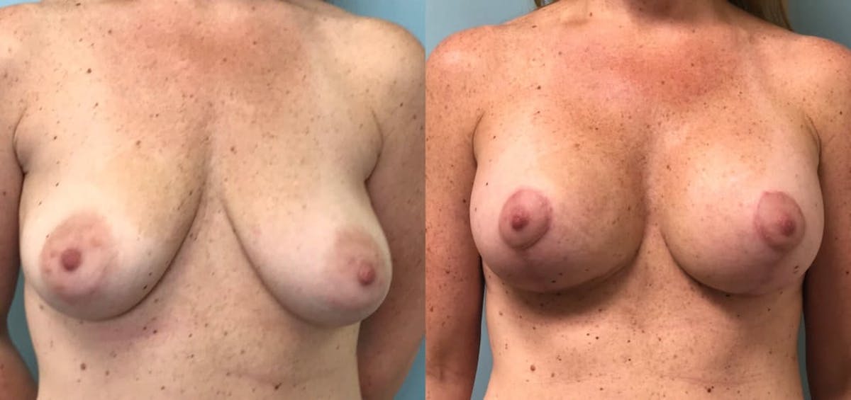 Breast Augmentation Before & After Gallery - Patient 124727 - Image 1