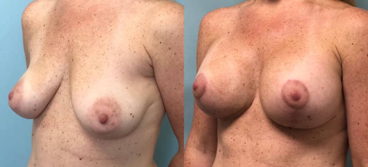 Breast Augmentation Before & After Gallery - Patient 124727 - Image 4