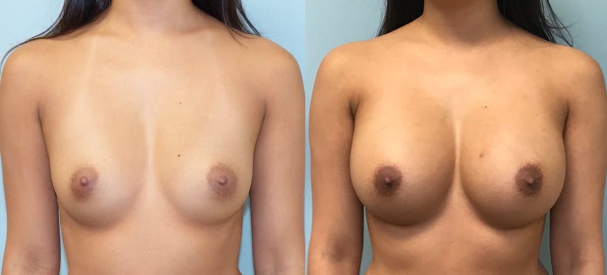 Breast Augmentation Before & After Gallery - Patient 176555 - Image 1